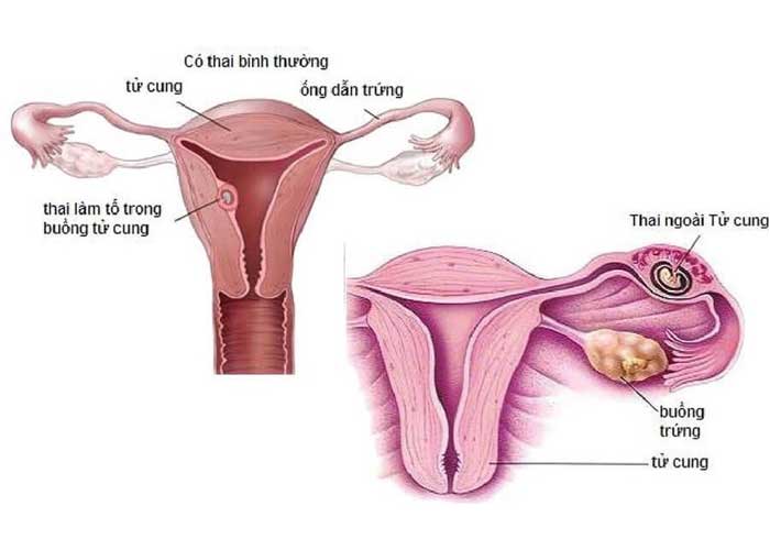 Dấu hiệu của viêm tử cung